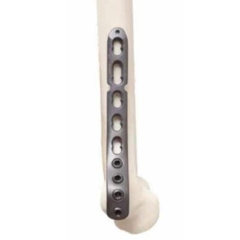 3.5 мм LCP Дистальна медіальна плечова пластина-1 з кутовою стабільністю (титанова) WegoOrtho